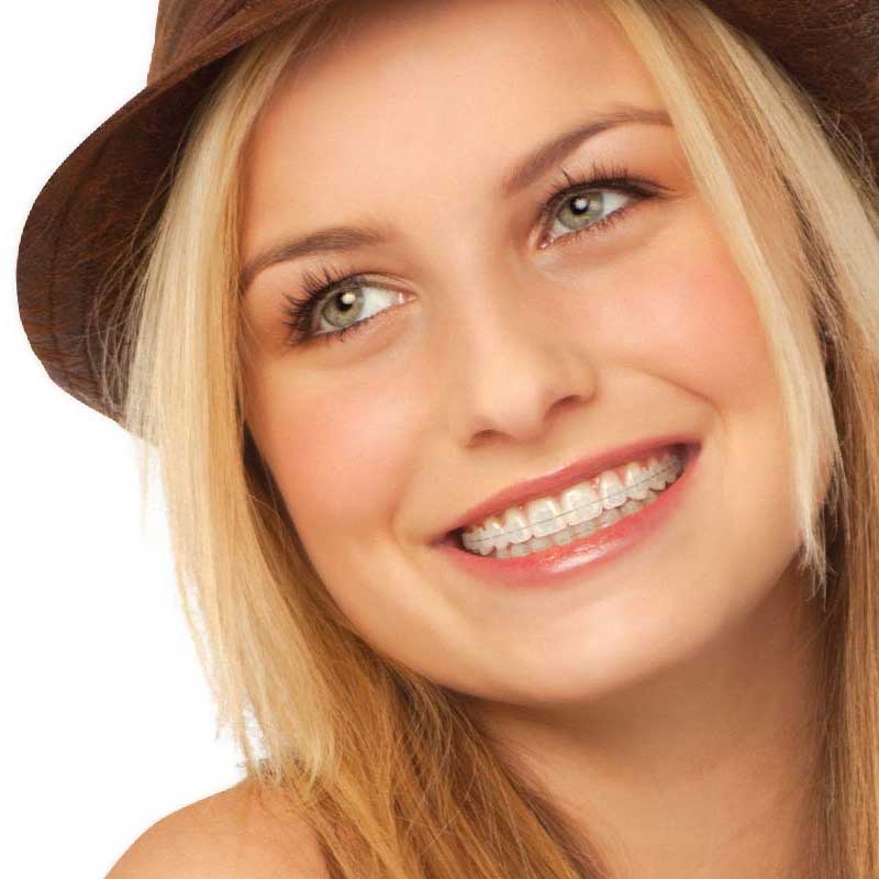 Types Of Braces Howard Beach Braces Arbitman Orthodontics 