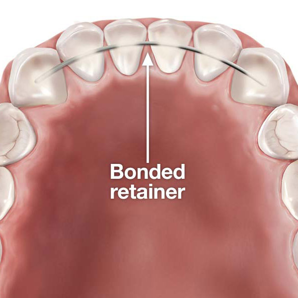 Fixed Retainers